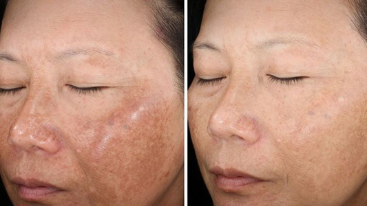 Melasma Tem Cura? O Que Dizem os Especialistas