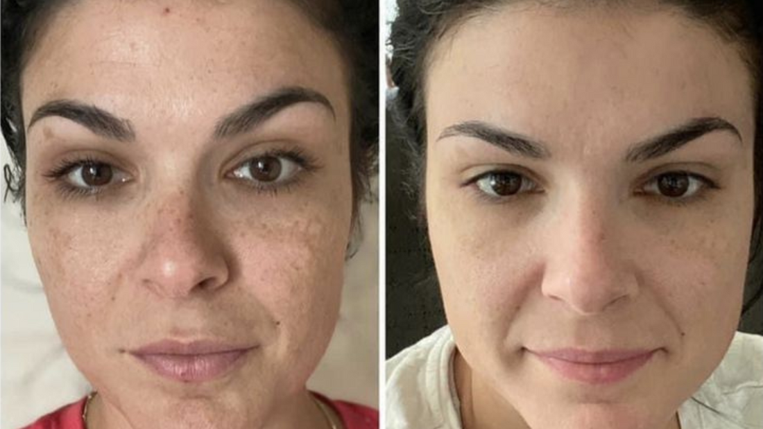 Top 5 Melhores Clareadores para Melasma em 2025