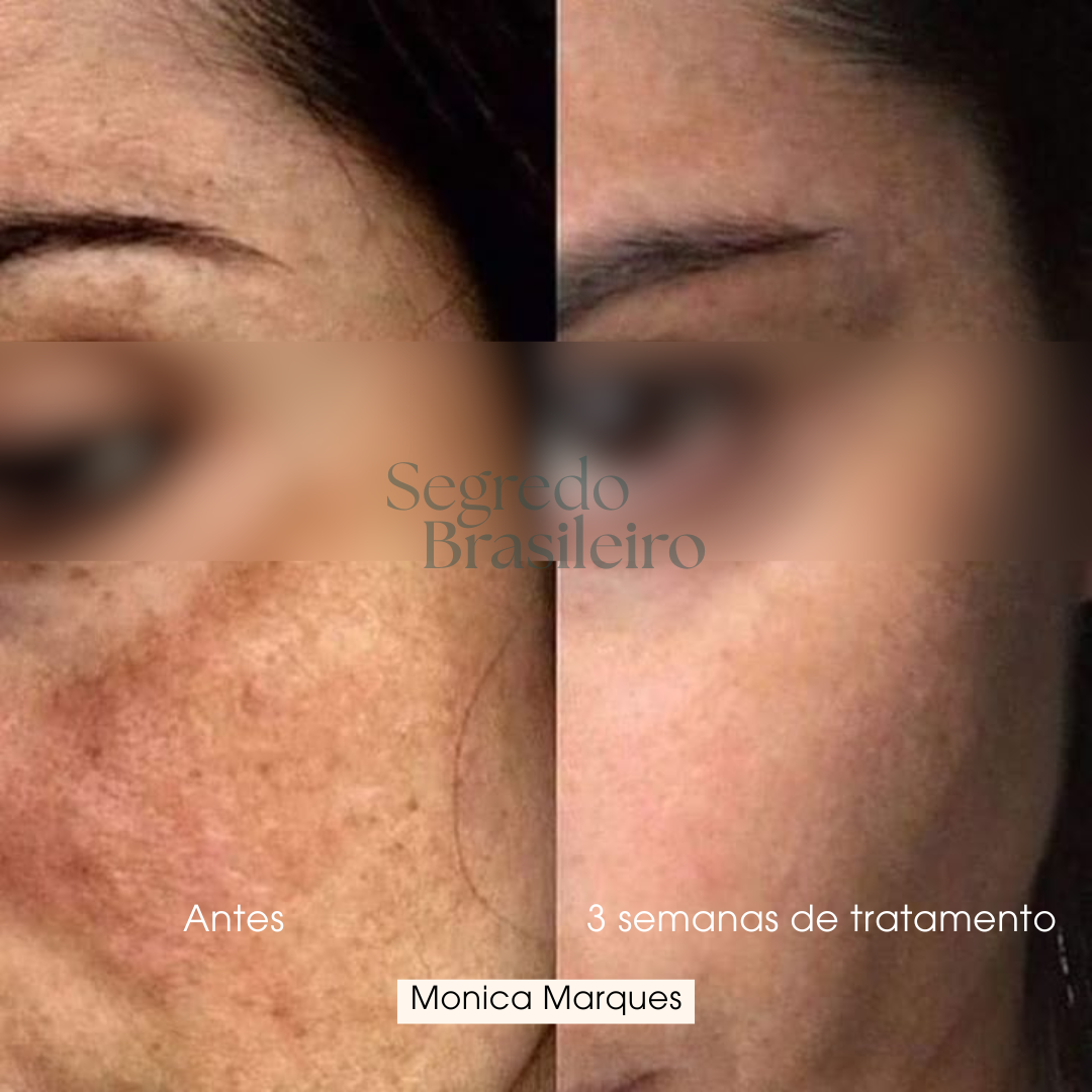 Sérum Anti Melasma - Segredo Brasileiro