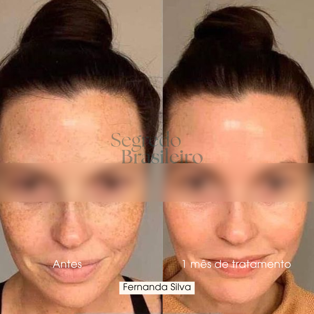 Sérum Anti Melasma - Segredo Brasileiro