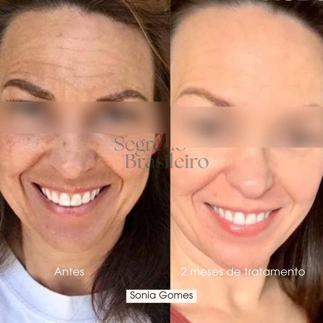 Sérum Anti Melasma - Segredo Brasileiro