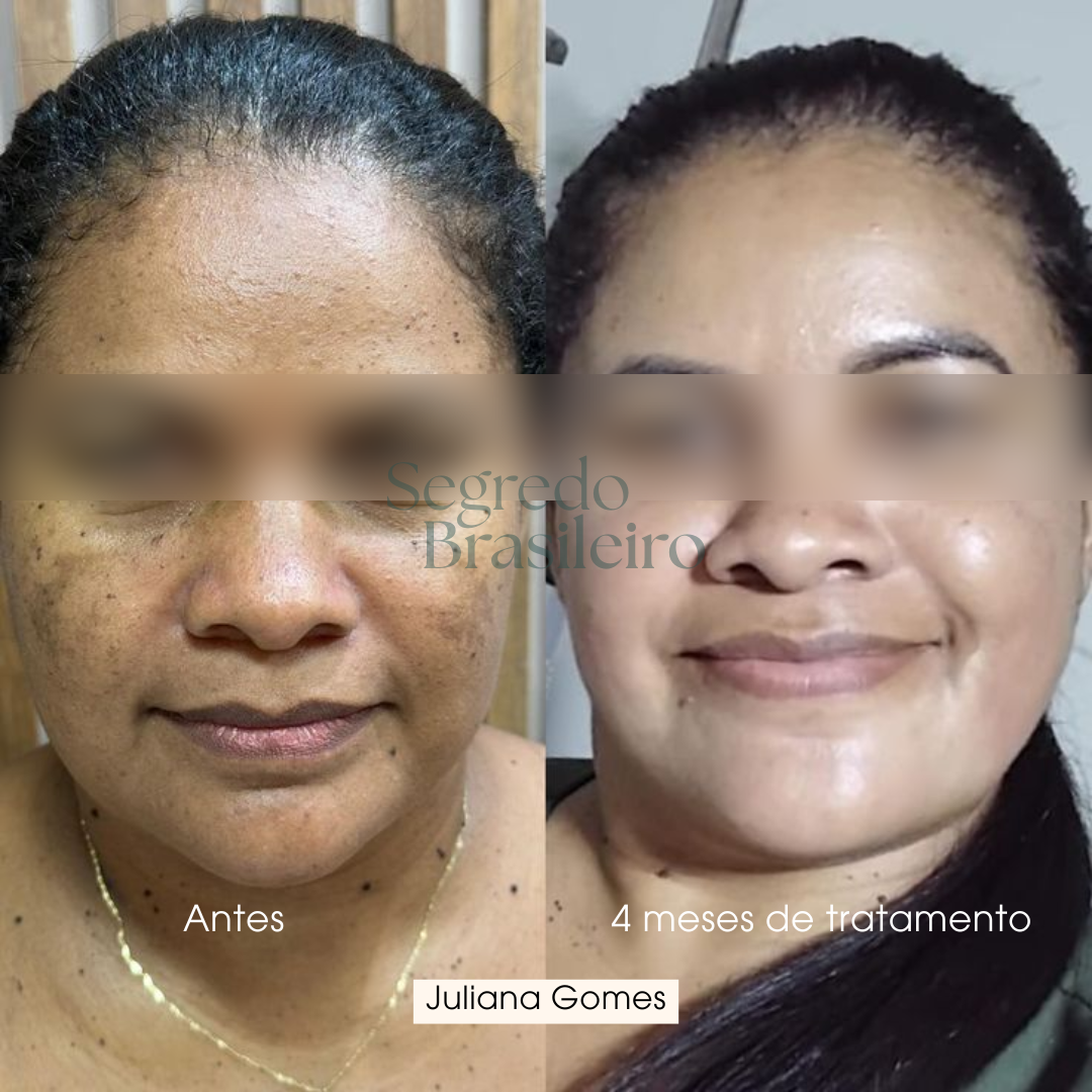 Sérum Anti Melasma - Segredo Brasileiro