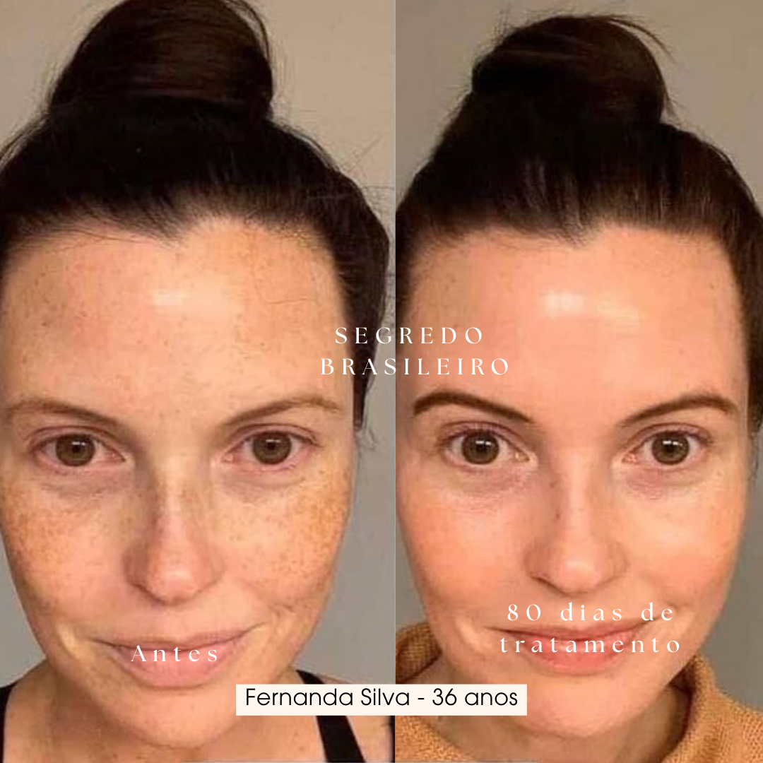 Segredo Brasileiro Anti Melasma | 1 Sérum 39% de desconto