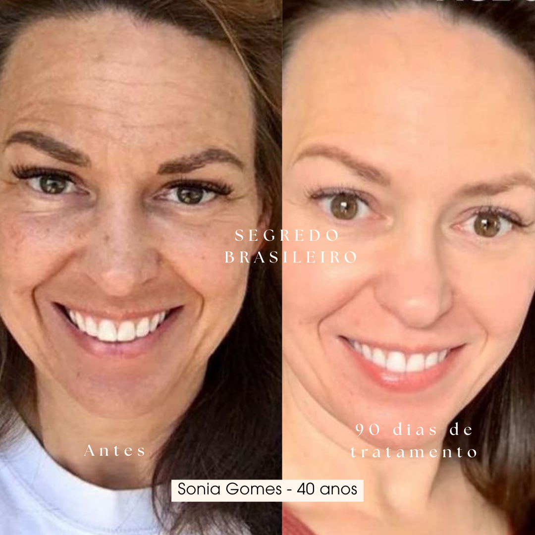 Segredo Brasileiro Anti Melasma | 1 Sérum 39% de desconto
