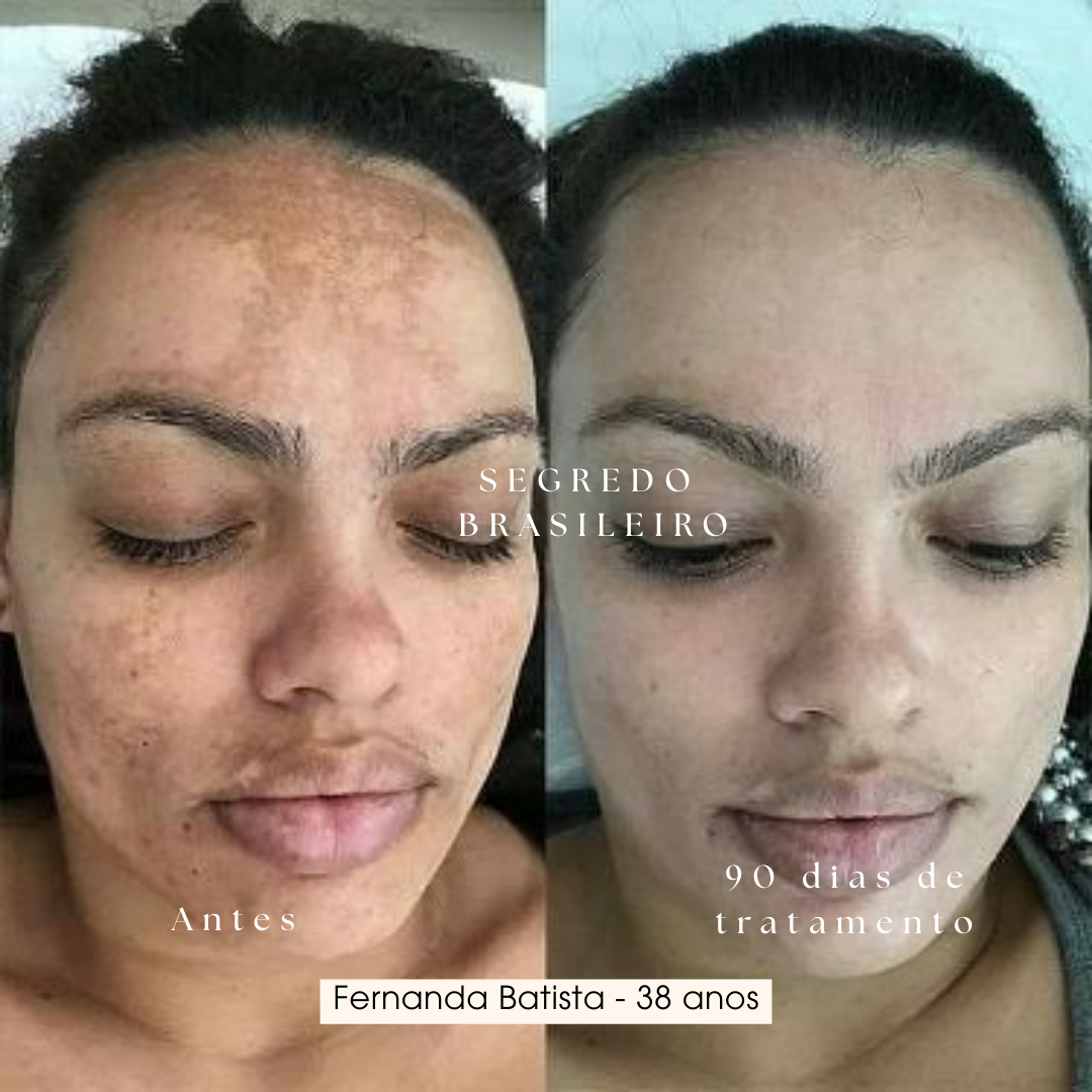 Segredo Brasileiro Anti Melasma | 1 Sérum 39% de desconto