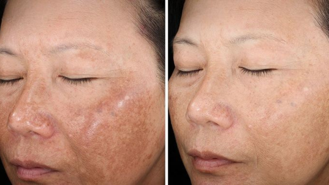 Melasma Tem Cura? O Que Dizem os Especialistas