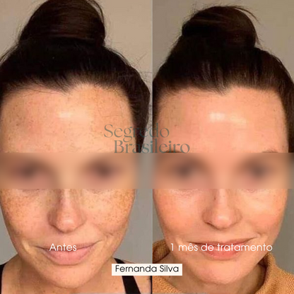 Sérum Anti Melasma - Segredo Brasileiro