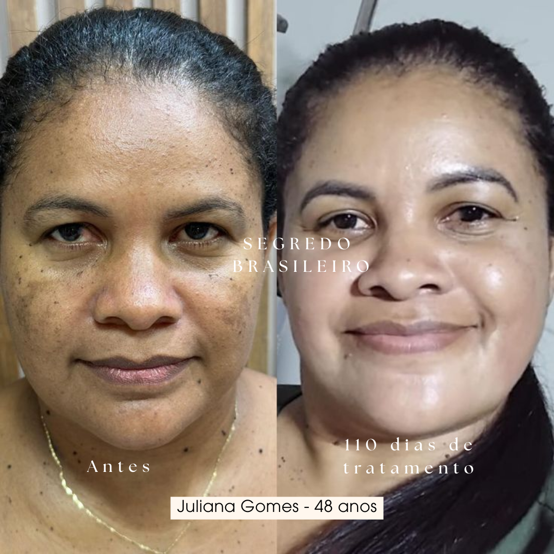 Segredo Brasileiro Anti Melasma | 1 Sérum 39% de desconto
